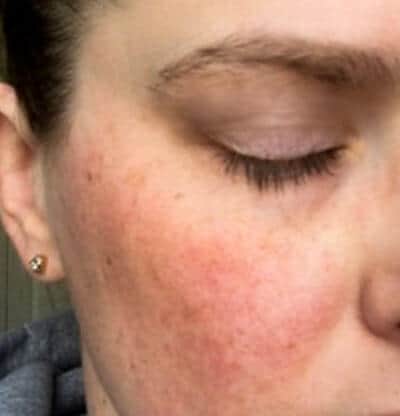 Rosacea bumps